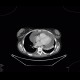 Cardiac tamponade, pericardial effusion: CT - Computed tomography